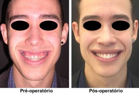 Sorriso gengival e ortognática 2