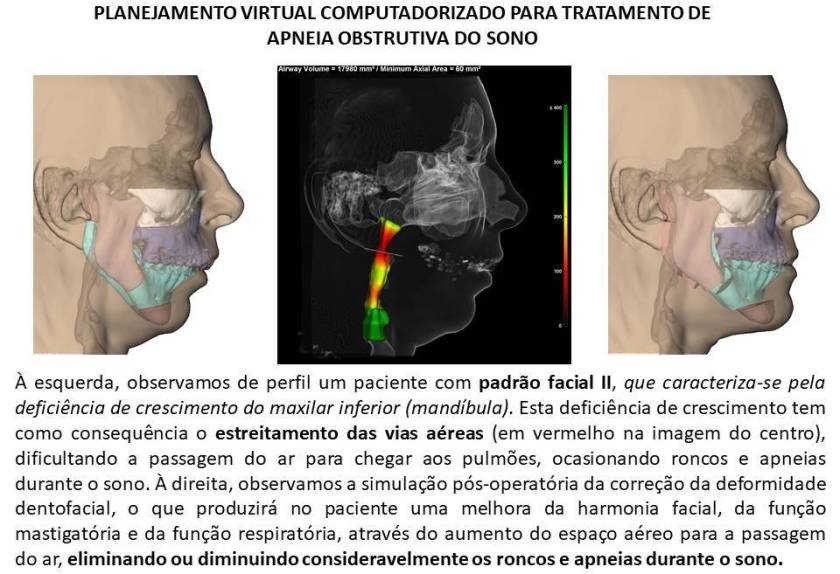 Sindrome da Apneia do Sono
