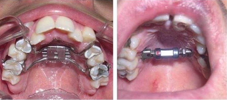 À esquerda, aparelho de HIRAX (dispositivo muito seguro e eficaz para a disjunção maxilar). À direita, DISTRATOR PALATAL (dispositivo colocado fixo somente ao palato, não causando nenhum tipo de inclinação dentária e proporcionando uma higiene oral normal. Ideal para pacientes com problemas periodontais).