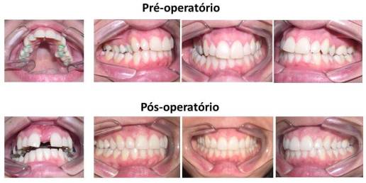 Disjunção de maxila assistida cirurgicamente. 