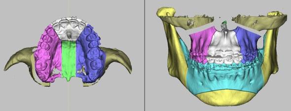 Segmentação de maxila