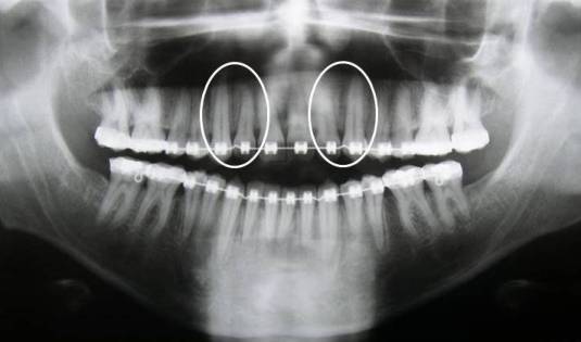 divergência de raízess