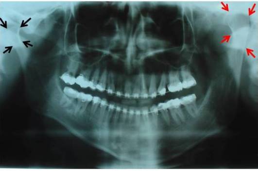 hiplerpasia de cõndilo 2