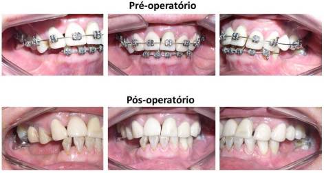 No pré-operatório observamos a falta de espaço protético em região posterior de mandíbula, principalmente à direita. No pós-operatório, após a cirurgia ortognática notamos a melhora considerável do espaço protético à direita. Foi feito também um leve desgaste da cúspide vestibular do primeiro pré-molar superior direito.