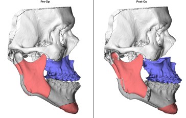 ortognática pré e pós