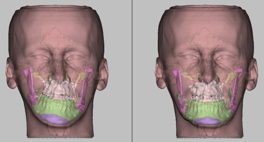 pré e pós virtual de asssimetria