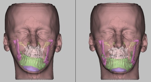 pré e pós virtual de asssimetria