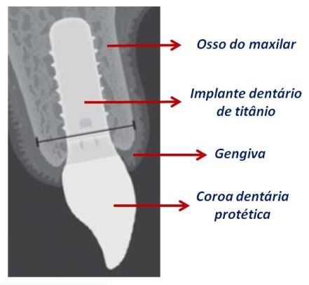 Implante dentário