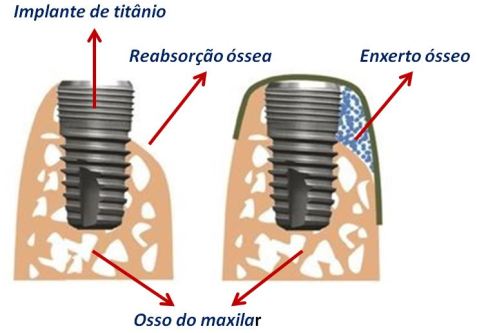 Implante dentátio e enxerto ósseo